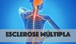 Information on ms in english, arabic and spanish. Esclerose Multipla O Que E Sintomas Diagnostico Tratamento Famosos
