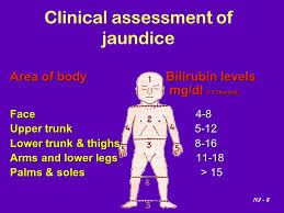 Neonatal Jaundice By Dr Nahed Al Nagger Ppt Video Online
