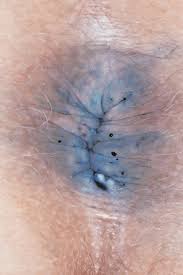 Image result for itchy skin rectum