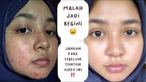 HATI HATI SEBELUM BELI ! NGGA NGEFEKK ?? REVIEW BENINGS INDONESIA PAKET ACNE