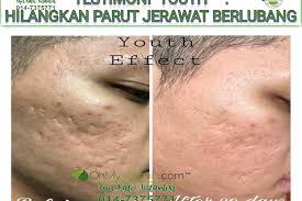 Parut jerawat bukan sahaja akan membuatkan wajah anda kelihatan kusam, malah ia juga boleh menyebabkan anda tidak yakin dengan diri anda sendiri. Testimoni Hilangkan Parut Jerawat Berlubang Selepas 20 Hari Dengan Skincare Youth Coach Bisnes Coach Detox Kurus Coach Penyusuan Susu Ibu Mentor Bisnes Pengedar Shaklee Pengedar Youth Pengedar Vivix 011 17547669