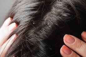 This is because frequent rubbing of the scalp can dislodge hair, especially in individuals who are already susceptible to hair fall. Can Dandruff Cause Hair Loss