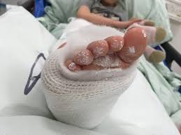 Maybe you would like to learn more about one of these? Girl Recovering In Hospital With Broken Leg After Plungington Crash Blog Preston