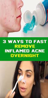 Inflamed Acne Can Usually Be Treated With Antibiotics Such As Tetracycline Doxycycline Minocycline Erythromycin And Coul Acne Overnight Inflamed Pimple Acne