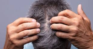 Image result for lice vs dandruff