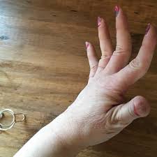 A finger splint is a medical devise that consists of a flat, padded, moldable, aluminum stick. Getting A Handle On Hand Pain And Reduced Function Due To Eds