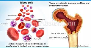 What is blood cancer symptoms and detection? Acute Myeloblastic Leukemia Or Acute Granulocytic Leukemia Causes Signs Symptoms Treatment