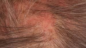 Diagnosis and treatment of lichen planus american. Lichen Planus Atrophicans Altmeyers Encyclopedia Department Dermatology