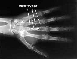 Image result for Hand Fracture