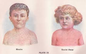 The return of scarlet fever: Is it too tough to treat? - The Washington Post