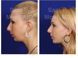 Sam P Most Chin Implant Chin Augmentation Facial Implant Chin Implant