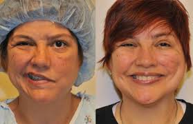 Jan 22, 2016 · the prognosis for individuals with bell's palsy is generally very good. Bell S Palsy Best Facial Paralysis Treatment Los Angeles Los Angeles California Pasadena Santa Monica Glendale