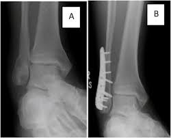 A weber type a lateral malleolar fracture is corrected using a large acutrak 2 5.5 screw. A Radiograph Showing Lateral Malleolus Fracture B Radiograph At Download Scientific Diagram