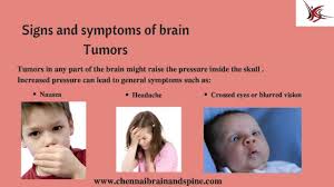 Pin By Rylee Gimenez 2021 On Pediatric Oncology Brain Tumor Tumor Pediatrics
