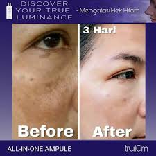 Pemakaian hari pertama untuk menghilangkan flek hitam di wajah. Penghilang Flek Hitam Pada Wajah Cepat Ganti Masker Wajah Dgn Trulum Shopee Indonesia