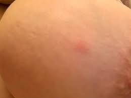 At age 30, the risk of developing breast cancer is 0.44. Need Advice 20 Years Old And Worried I Have Ibc Should I Be Worried Breastcancer