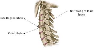 Cervical Spondylosis Rehabexercise Org