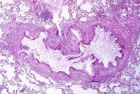 Study Reveals Nervous System S Role In Asthma Attacks