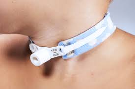 Image result for Tracheostomy