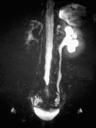 Image result for Acute Pyelonephritis