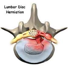 Protruzie de disc, herniere, herniere cu sechestrare (fragment liber discal). Hernia De Disc Lombara