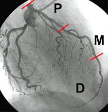 Analysis of 207 cadaver coronary arteries showed left coronary artery (lca) dominance type was present in 6.3% of there were also differences in the number of diagonal arteries in the dissected samples. Imaging Of All Three Coronary Arteries By Transthoracic Echocardiography An Illustrated Guide Cardiovascular Ultrasound Full Text