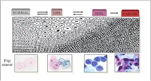 Survival rates for cervical cancer. New Biomarkers For Cervical Cancer Perspectives From The Igf System Intechopen