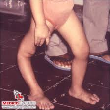 Image result for Polio