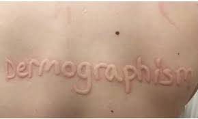 Image result for Dermatographism