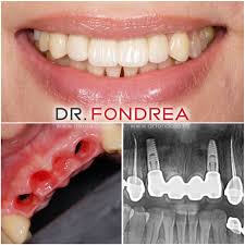 Sangerarea gingiilor poate fi un semn al gingivitei, care se poate agrava si va fi mult mai greu de tratat. Dr Bogdan Fondrea