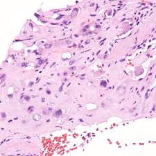 Hemangioendotelioma epitelioide – Wikipédia, a enciclopédia livre