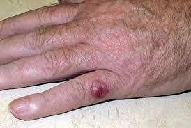 Image result for Merkel Cell Carcinoma