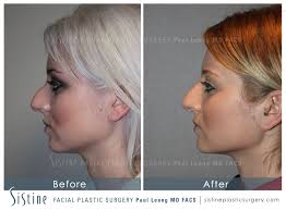 Maybe you would like to learn more about one of these? Rhinoplasty Before And After 19 Sistine Facial Plastic Surgery
