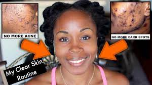 Managing hyperpigmentation during and after menopause. Get Rid Of Acne Scars Dark Spots And Hyperpigmentation My New Daily Face Care Routine Youtube