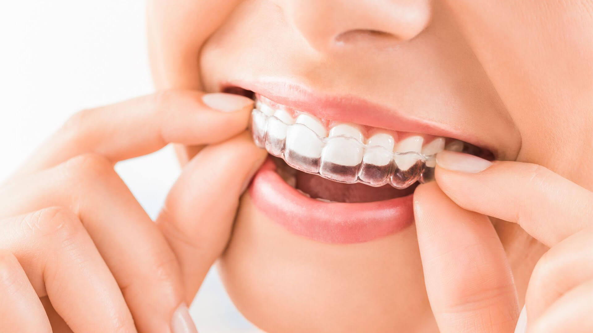 Invisalign product image