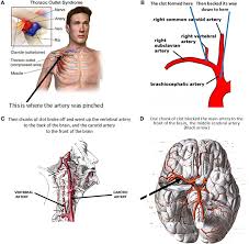 This recognises and celebrates the commercial success of music recordings and videos released in the uk. Big Surprise The Brain Can Recover Many Years After A Stroke Frontiers For Young Minds