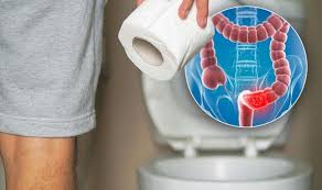Colon cancer is known to start forming as benign polyps. Bowel Cancer Symptoms Signs Of A Tumour In The Toilet And Stools Include Blood In Poo Express Co Uk