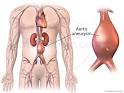 نتیجه تصویری برای علائم دایسکشن آئورت شکمی چیست
