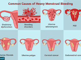Fibroids are tumour like growths in the uterus. Common Conditions That Can Affect The Uterus
