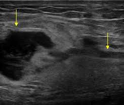 Image result for Nodular Lymphangitis
