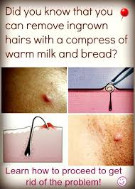 You Can Use Milk And Bread To Get Rid Of The Ingrown Hairs Here S How Ilovebeautytips Com Ingrown Hair Ingrown Hair Removal Ingrown Hair Remedies
