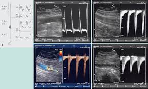 Ultraschalldiagnostik In Der Gefasschirurgie Springerlink