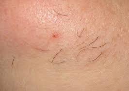 Some women with sensitive skin may not be able to but, it does a great job on small hair patches and especially fine hairs. Electrolysis Case Study Follikill Electrolysis Toronto