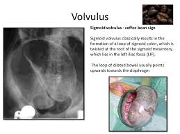 Sigmoid Volvulus Coffee Bean Sign Radiographer Sigmoid Colon Coffee Beans