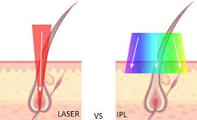 But what is ipl exactly? Ipl Hair Removal Vs Laser Hair Removal The Ultimate Comparison Guide Radar Magazine