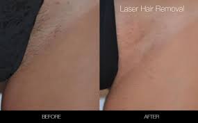 We make sure your treatments are private and comfortable Brazilian Laser Hair Removal In Toronto Spamedica