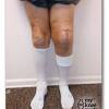 After partial knee replacement osteoarthritis may have advanced to other compartments of the knee. 1