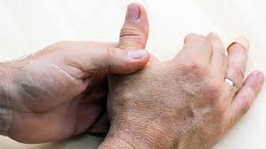 We did not find results for: Arthrose Symptome Erkennen Und Behandlung Ndr De Ratgeber Gesundheit