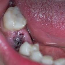 Image result for Post-Tooth Extraction Bleeding