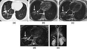 Severe stromal fibrosis, plethora, hypertrophy of muscle. Mri Of Cystic Fibrosis Lung Manifestations Sequence Evaluation And Clinical Outcome Analysis Clinical Radiology